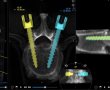 שערי צדק: לראשונה שולב מכשיר CT חדש הנותן תמונות תלת מימד און ליין תוך כדי ניתוח עמוד שדרה
